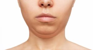 Get Rid of a Double Chin