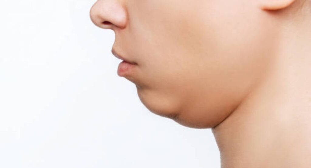 Get Rid of a Double Chin