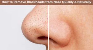 Get Rid of Blackheads