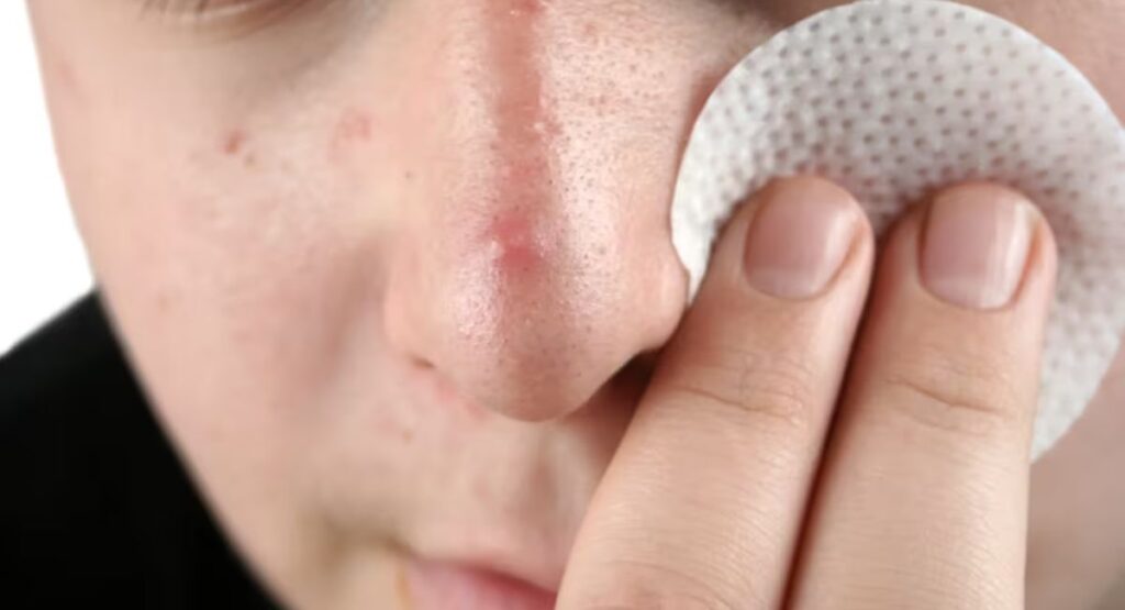 Get Rid of Blackheads